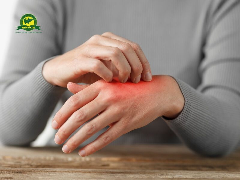 Trà hoa cúc gây dị ứng